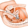 ecografia transvaginale esplorazione