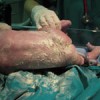 neonato in ospedale con vernice caseosa