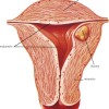 metrorragia, emorragia