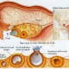 insufficienza luteale