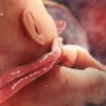 cordone ombelicale attorcigliato feto