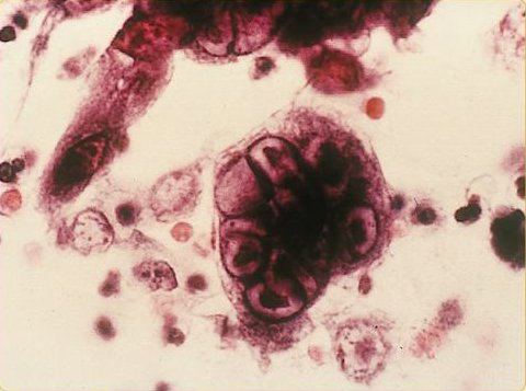 malattie veneree herpes genitale infezione