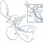 trachea neonato