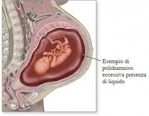 cosa-succede-polidramnios