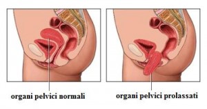 prevenire-il-prolasso-utero