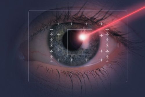 laser occhi in gravidanza