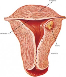 metrorragia, emorragia 