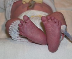 acrocianosi-neonatale