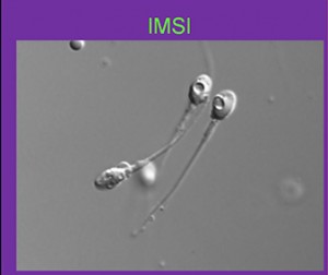 iniezione intra-citoplasmica di spermatozoi morfologicamente selezionati